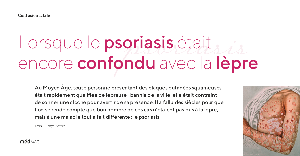 Confusion fatale: Lorsque le psoriasis était encore confondu avec la lèpre